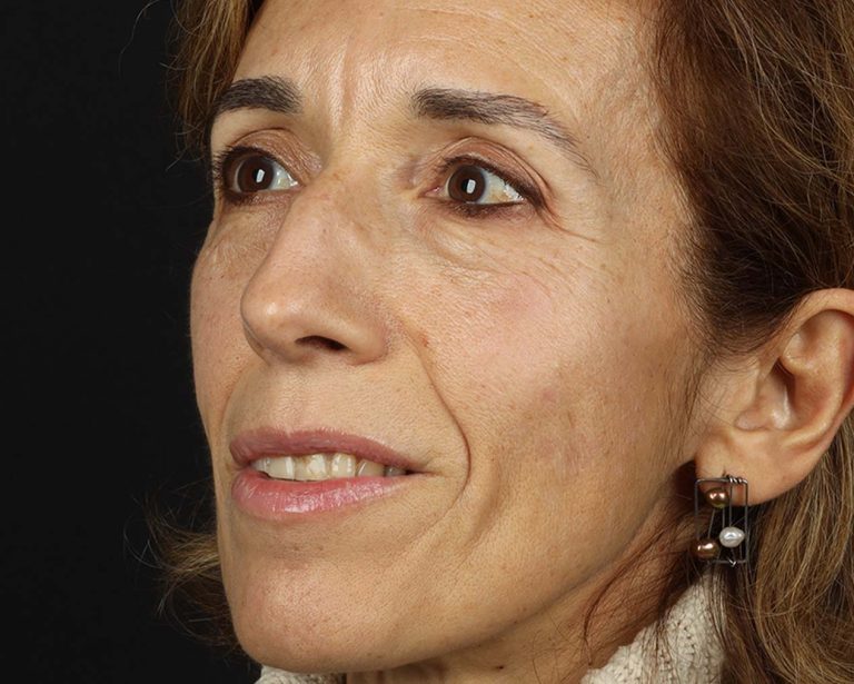 medicina estetica facial depois