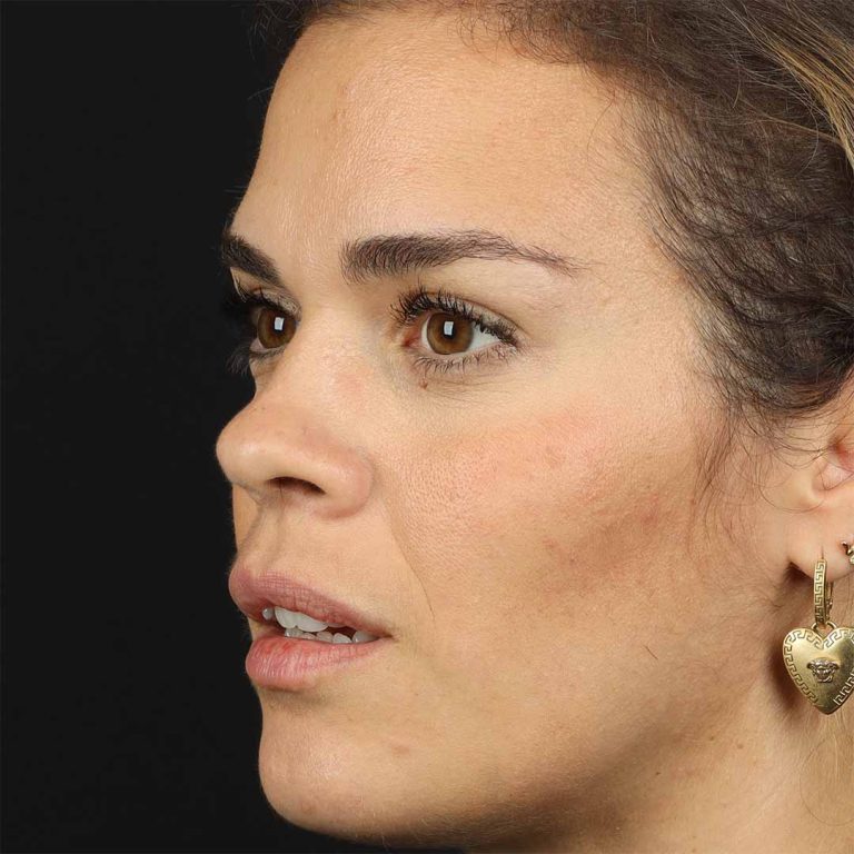 toxina-botulinica medicina estetica facial