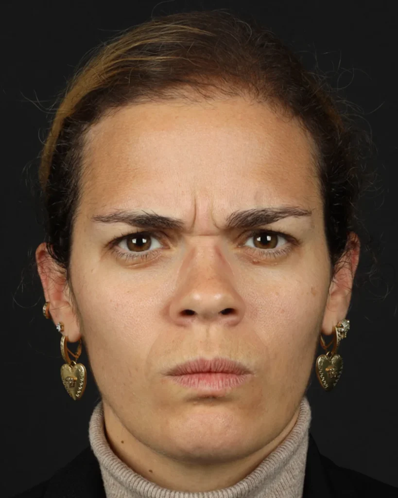 toxina-botulínica-antes