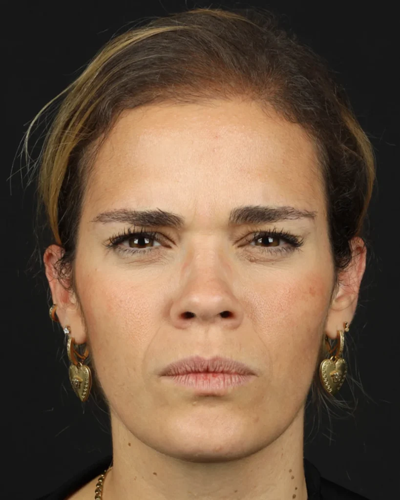 toxina-botulínica-depois