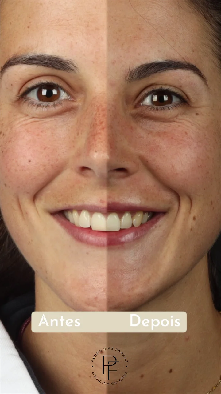 acido hialuronico antes depois