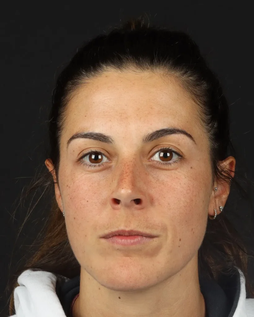 acido-hialuronico-labios-antes