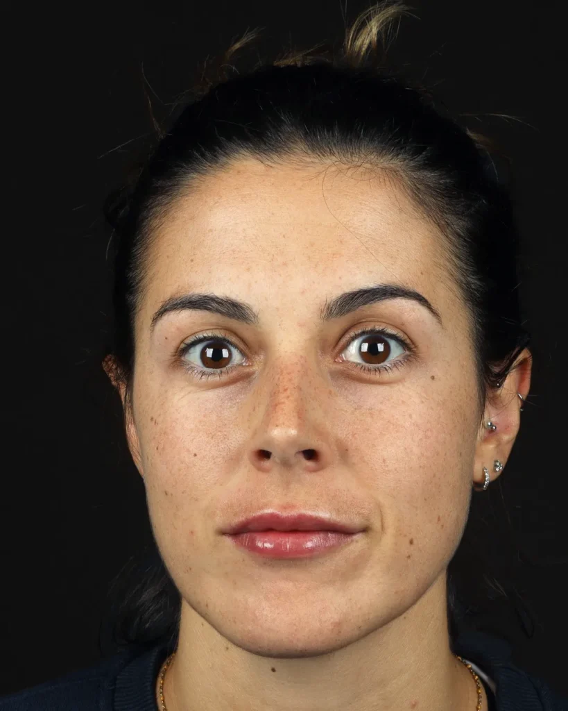 acido-hialuronico-labios-depois