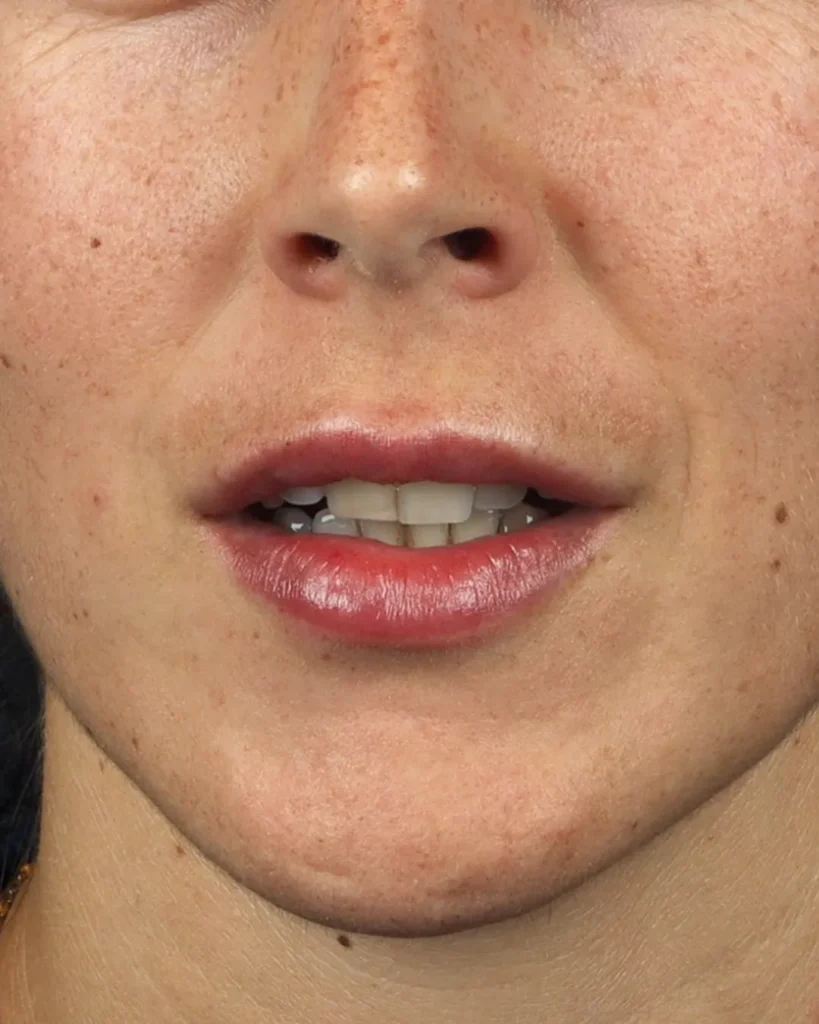 acido hialuronico labios frente a