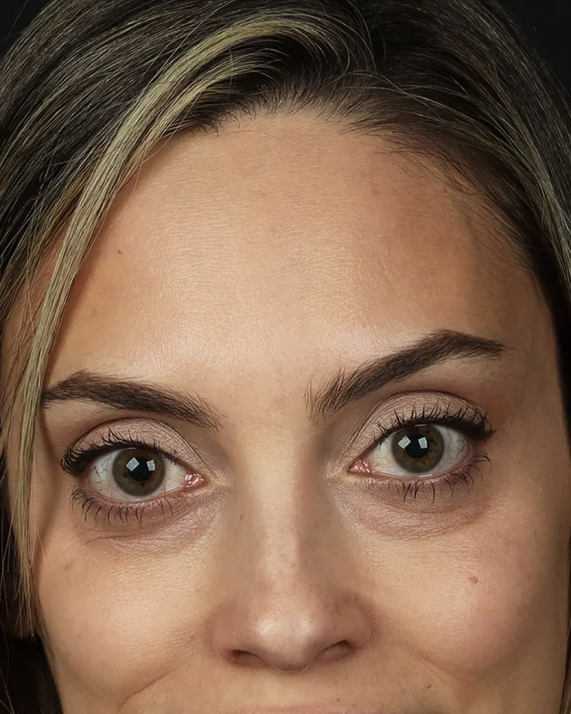 acido-hialuronico-olheiras