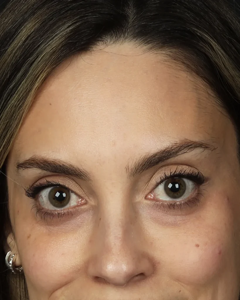 acido-hialuronico-olheiras