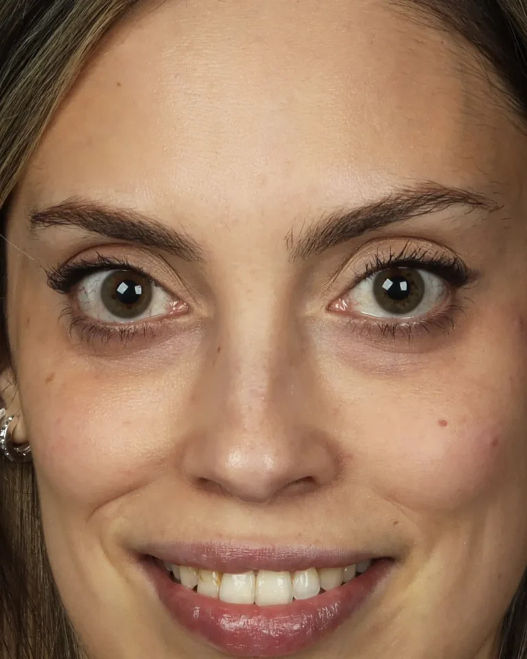 acido-hialuronico-olheira-depois-frente