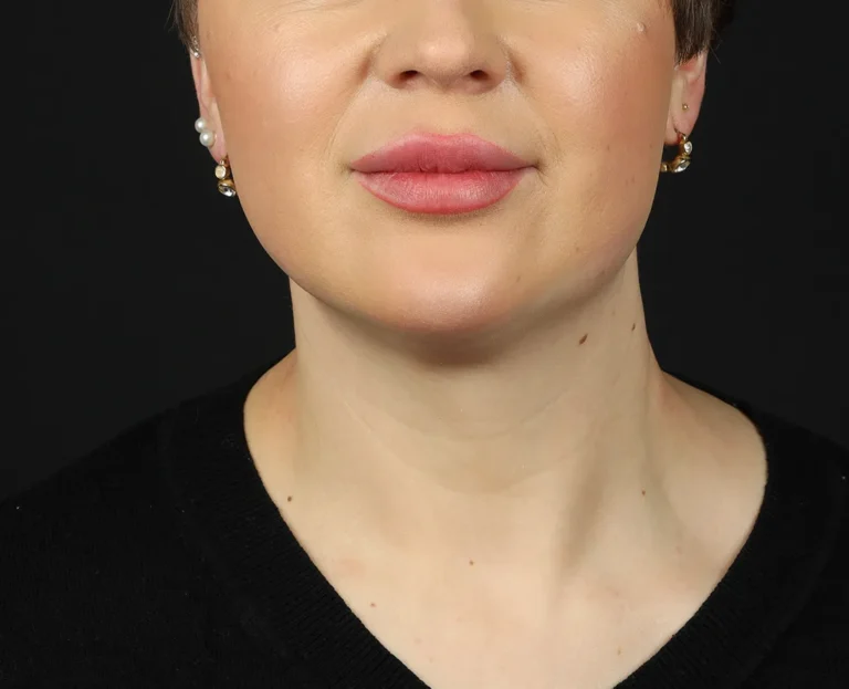 estetica-ultraformerIII-papada