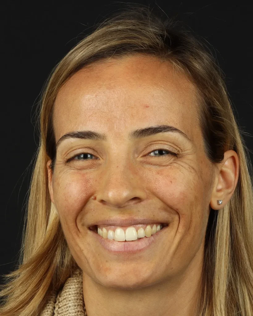 laser-fotona-rejuvenescimento