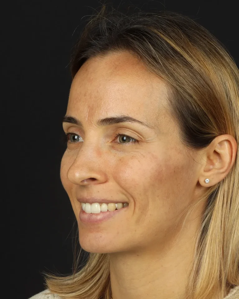 laser-fotona-rejuvenescimento