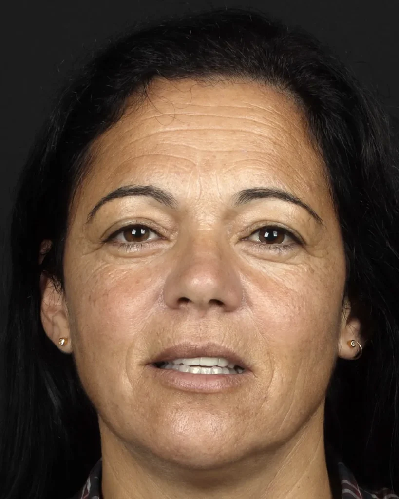 toxina-botulinica-reducao-rugas