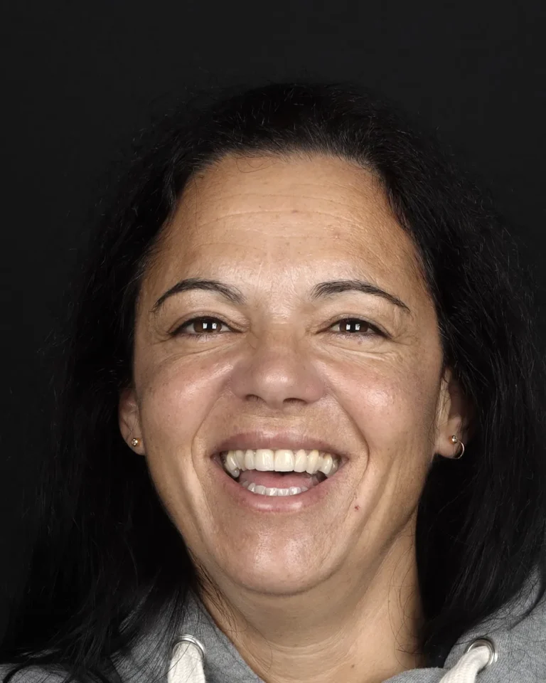 toxina-botulinica-reducao-rugas