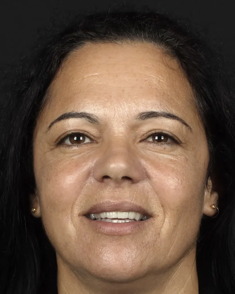 toxina-botulinica-reducao-rugas